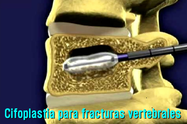 Fracturas vertebrales en Toluca