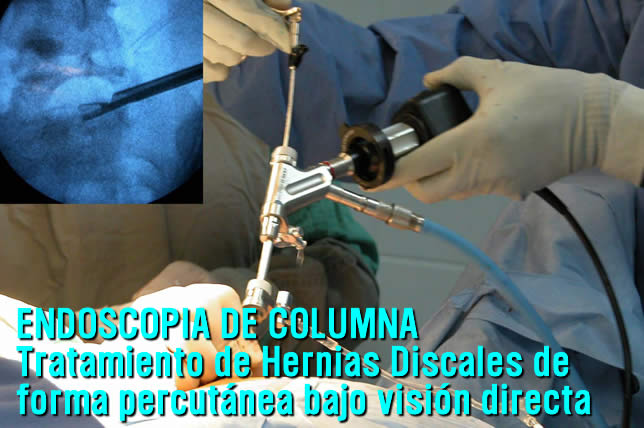 Endoscopia de columna en Toluca y Metepec